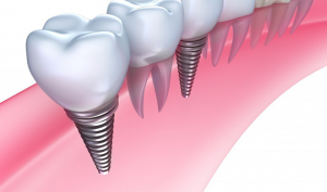 Periodontal scaling and root planing procedure being performed by a dental professional